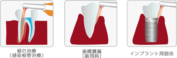 光殺菌の治療