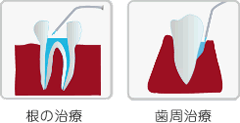 光感受性ジェルの注入