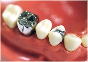イメージ：虫歯の治療法